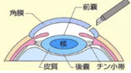 白内障の手術方法