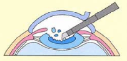 白内障の手術方法