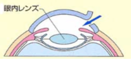 白内障の手術方法